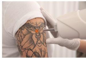 αφαίρεση tattoo με laser